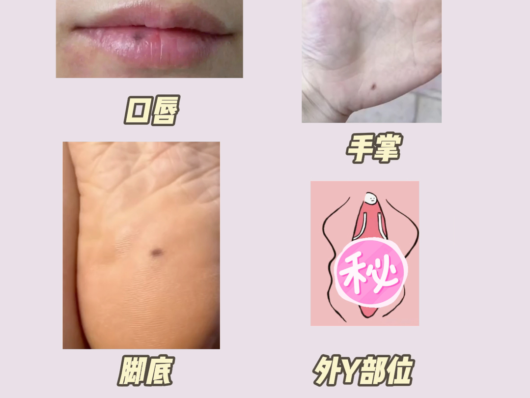 什么是色素痣?要不要切除?哔哩哔哩bilibili