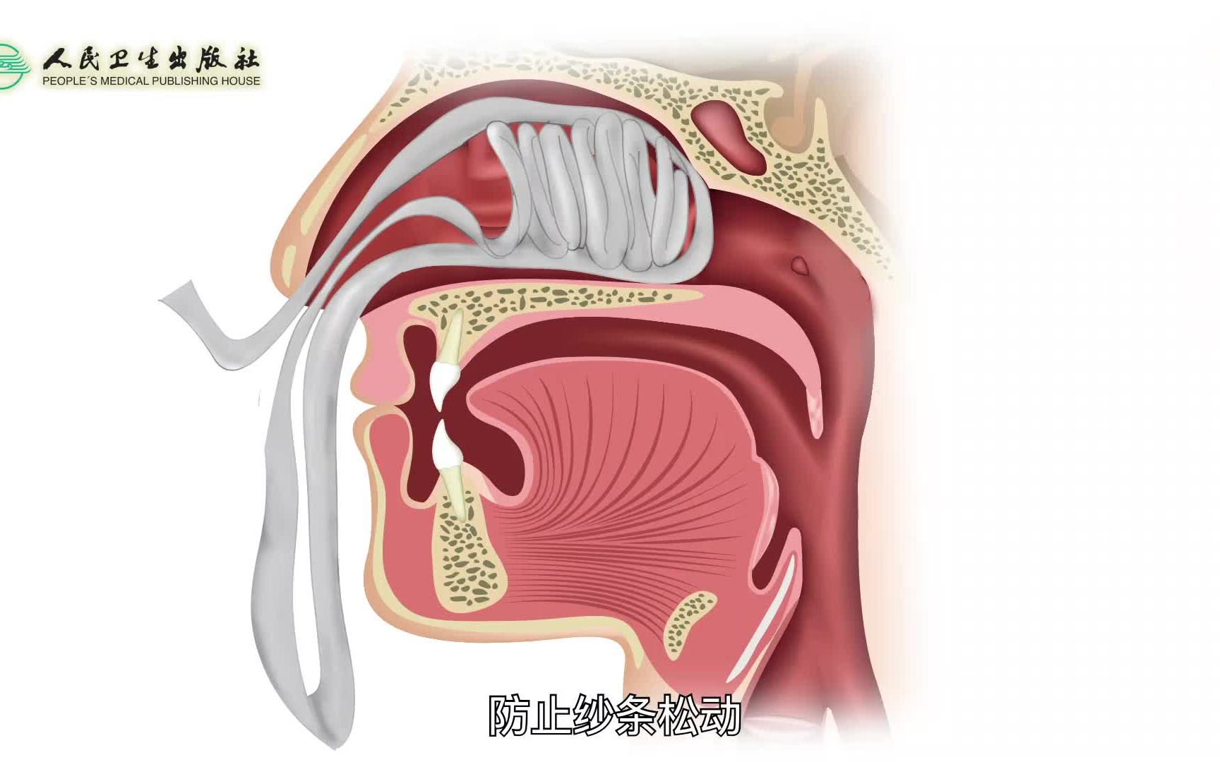 前鼻孔填塞术哔哩哔哩bilibili