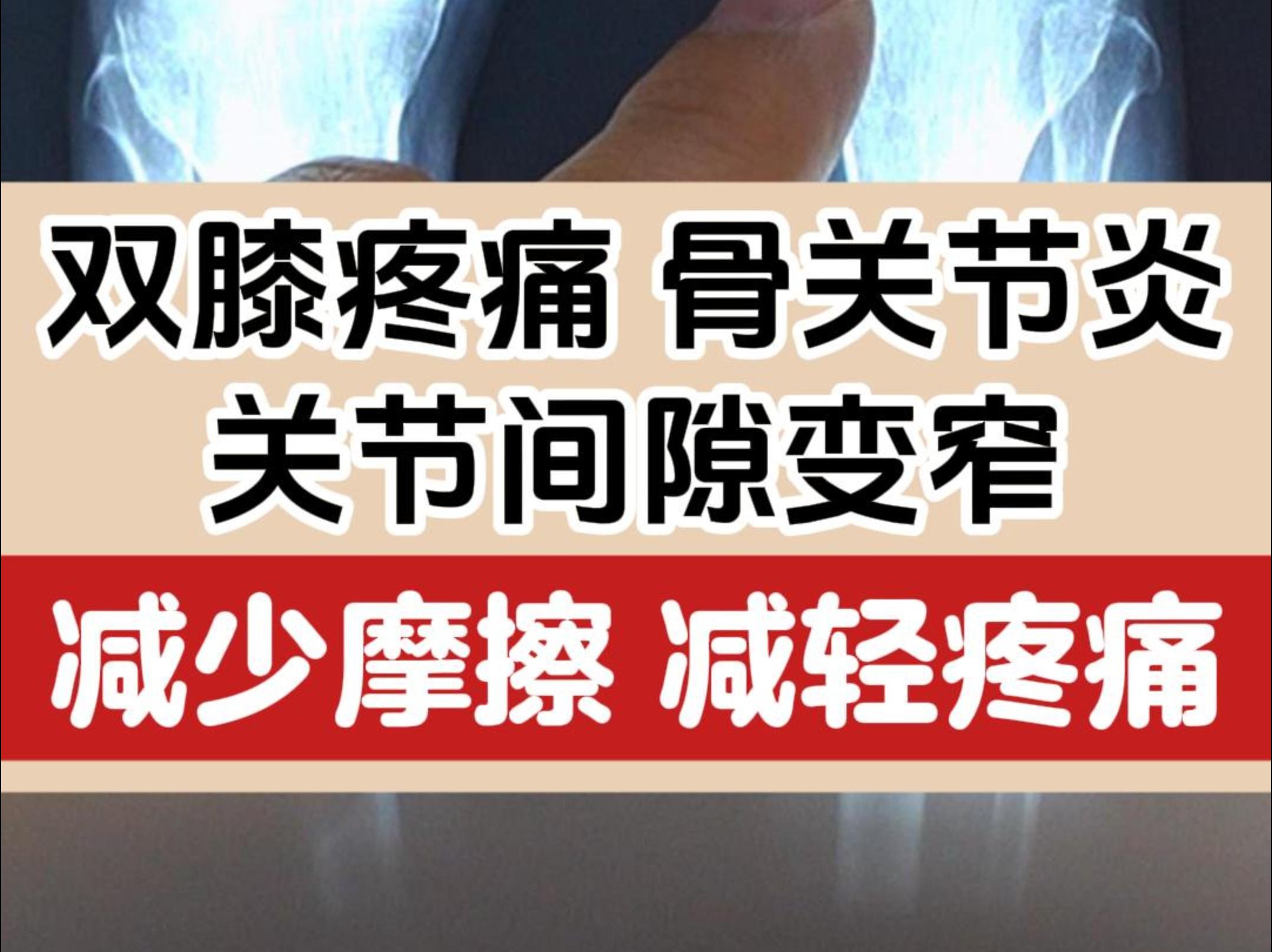 双膝疼痛,骨关节炎,关节间隙变窄,减少摩擦就能减轻疼痛