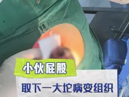 Télécharger la video: 小伙屁股取下一大坨病变组织