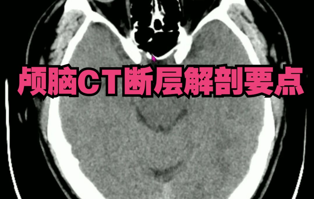 [图]颅脑CT断层解剖基础，3分钟认识颅脑CT关键解剖位置。