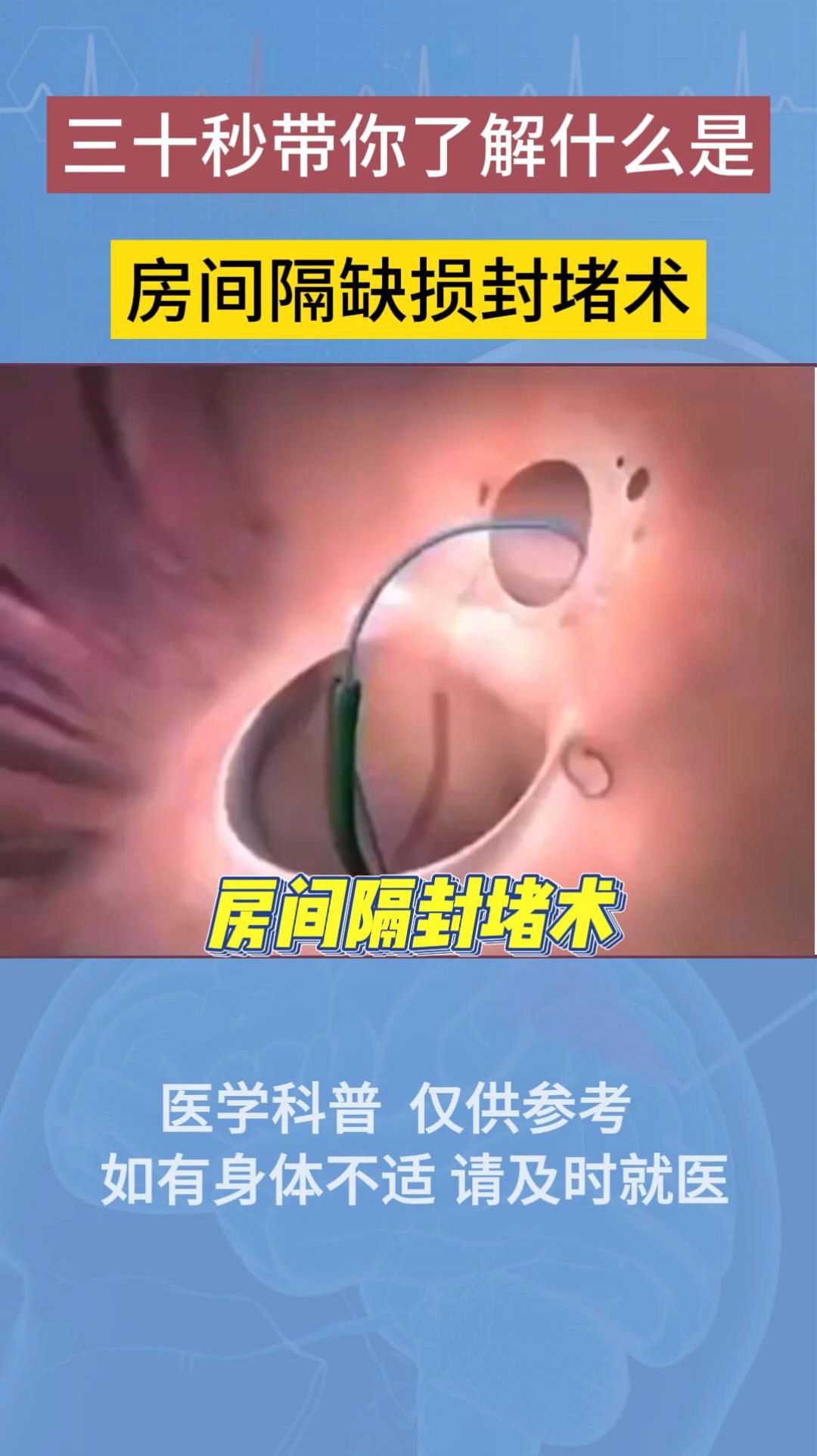 三十秒带你了解什么是房间隔缺损封堵术