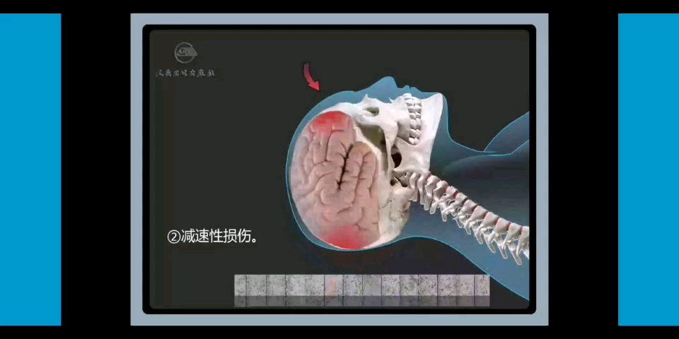 [图]【外科学】颅脑损伤方式