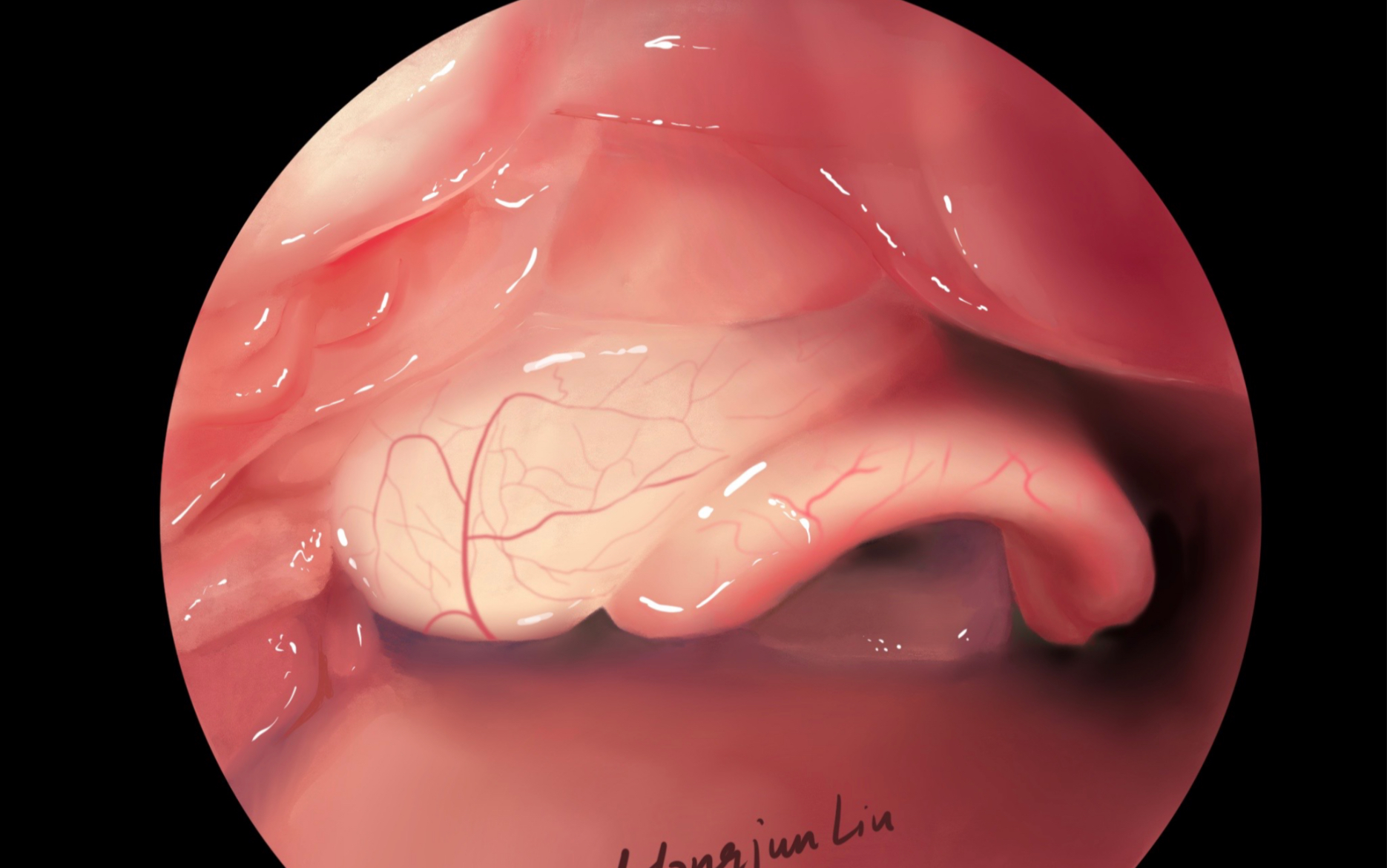【手绘解剖】会厌囊肿哔哩哔哩bilibili