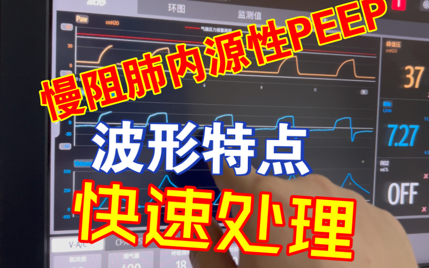 战胜慢阻肺内源性PEEP:实用指南,不再迷茫!哔哩哔哩bilibili