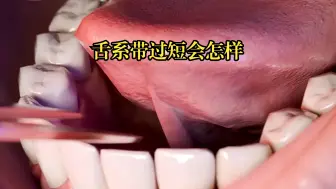 Download Video: 你们知道舌系带过短会发生什么吗？看完你就明白了。