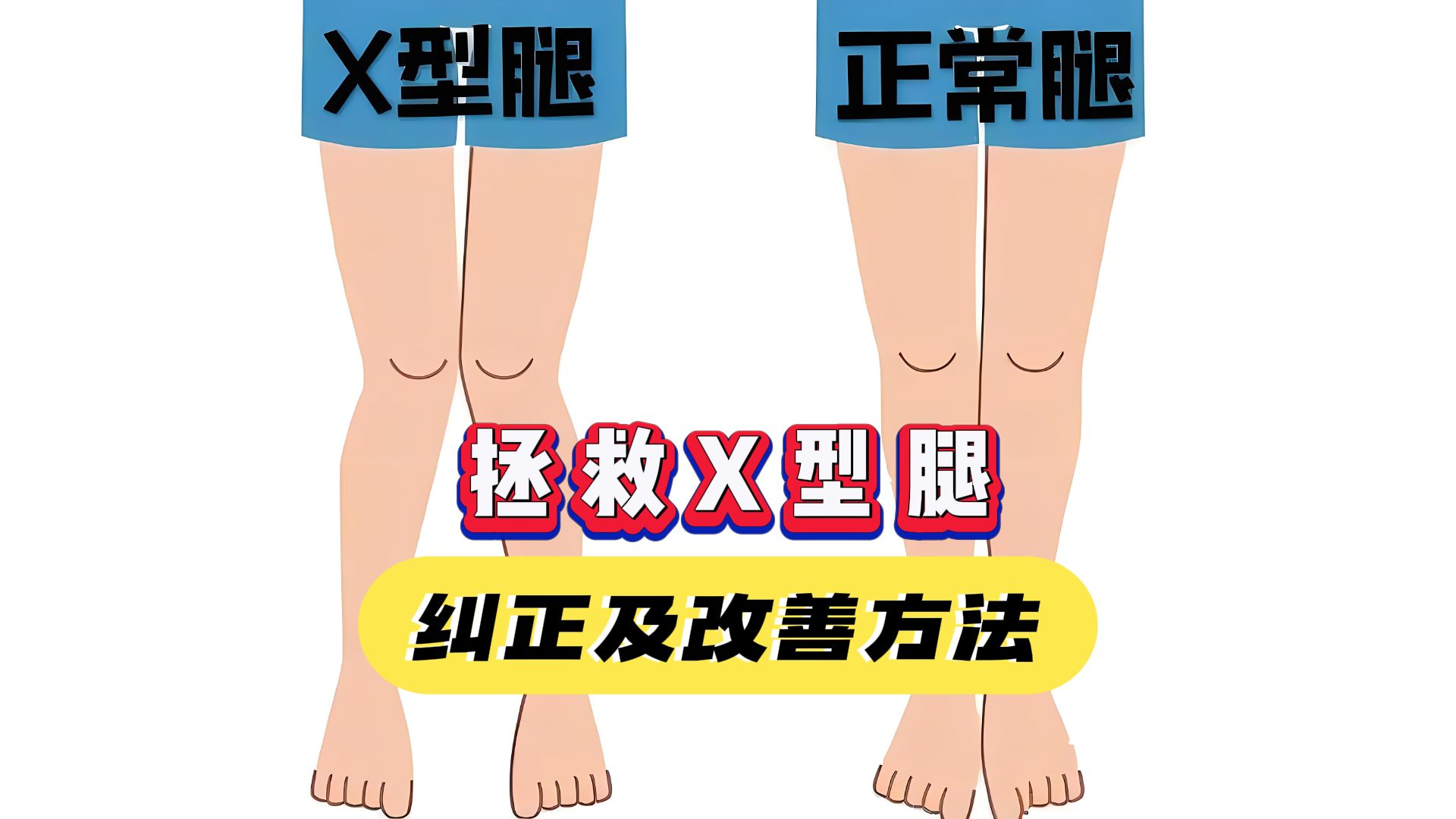 【x型腿】自我矫正,每天跟练一遍,轻松矫正x腿