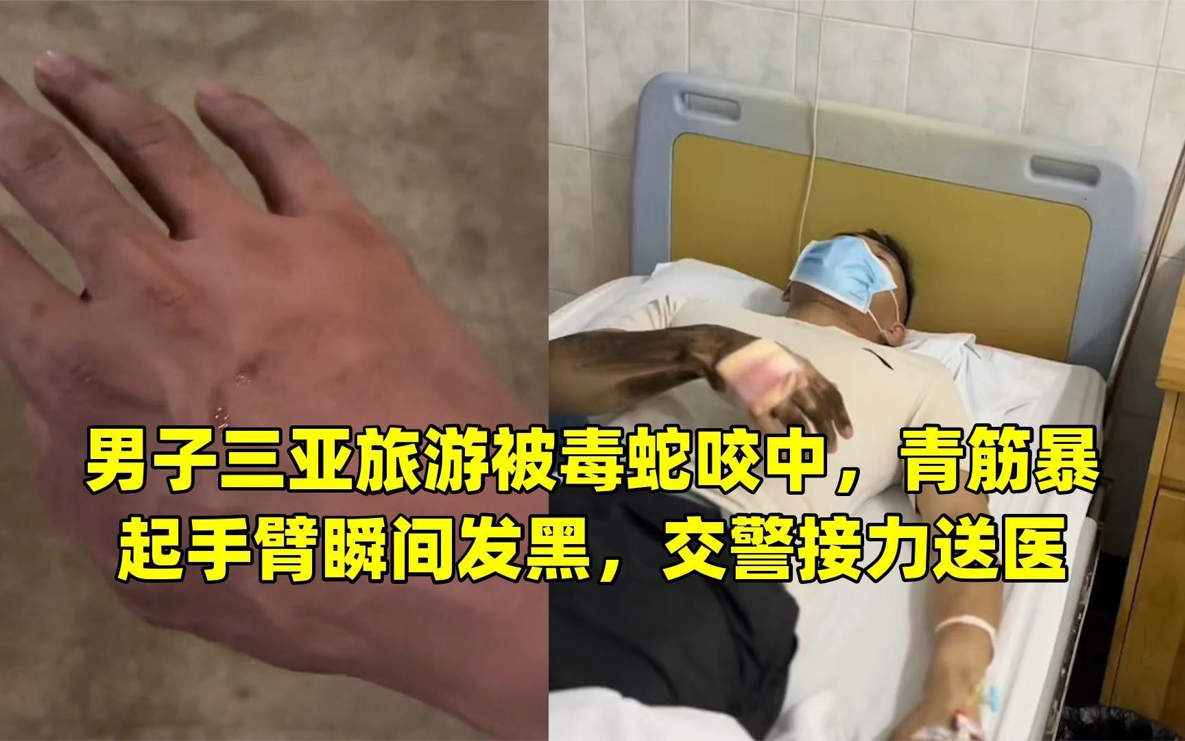 男子三亚旅游被毒蛇咬中,青筋暴起手臂瞬间发黑,交警接力送医