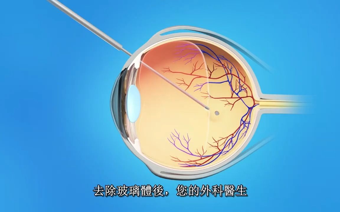 【中英双字】【黄斑裂孔:玻璃体切除术/玻切】Macular Hole:Vitrectomy Surgery哔哩哔哩bilibili