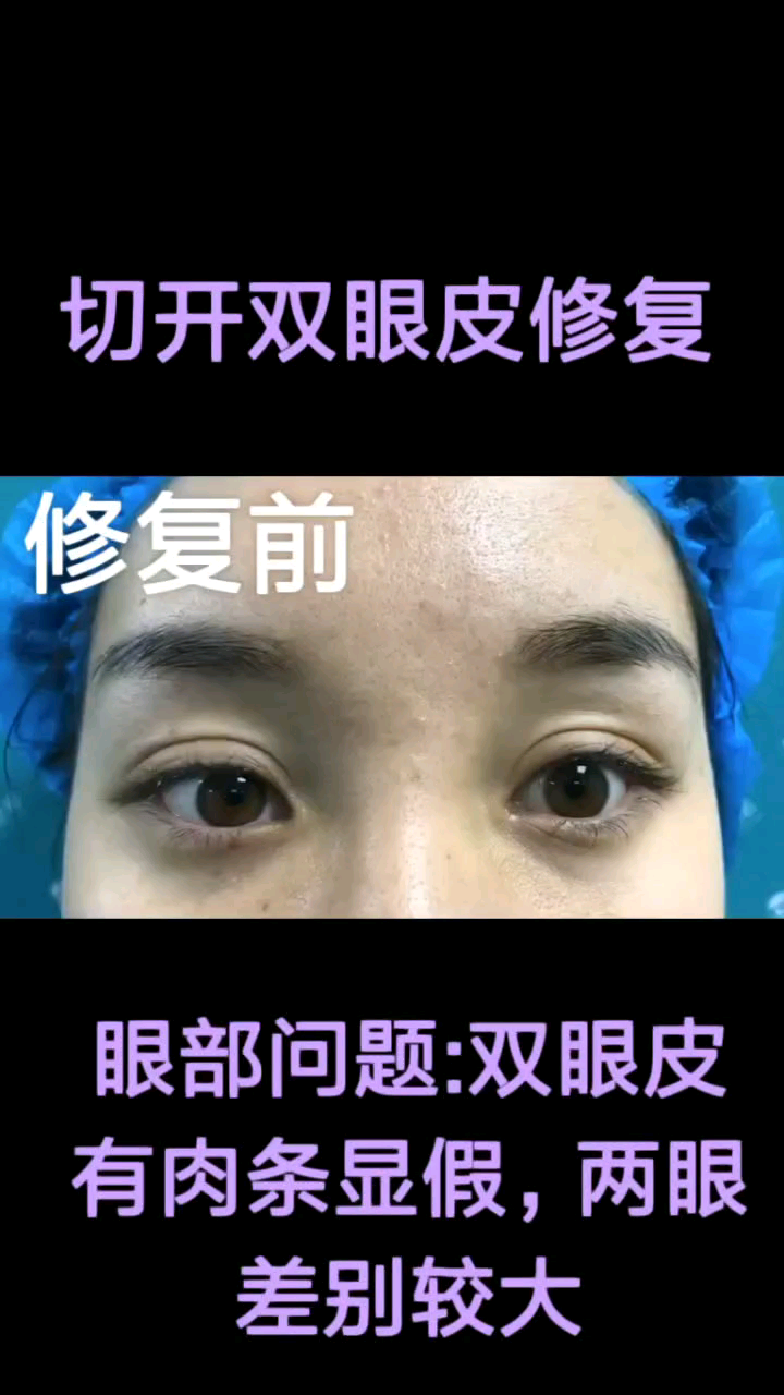 郑州双眼皮修复术+开外眦+下睑下至:来自哔哩哔哩bilibili