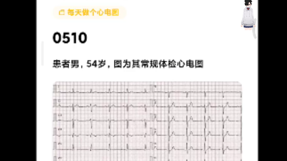 0510每天一份心电图,左前分支阻滞哔哩哔哩bilibili