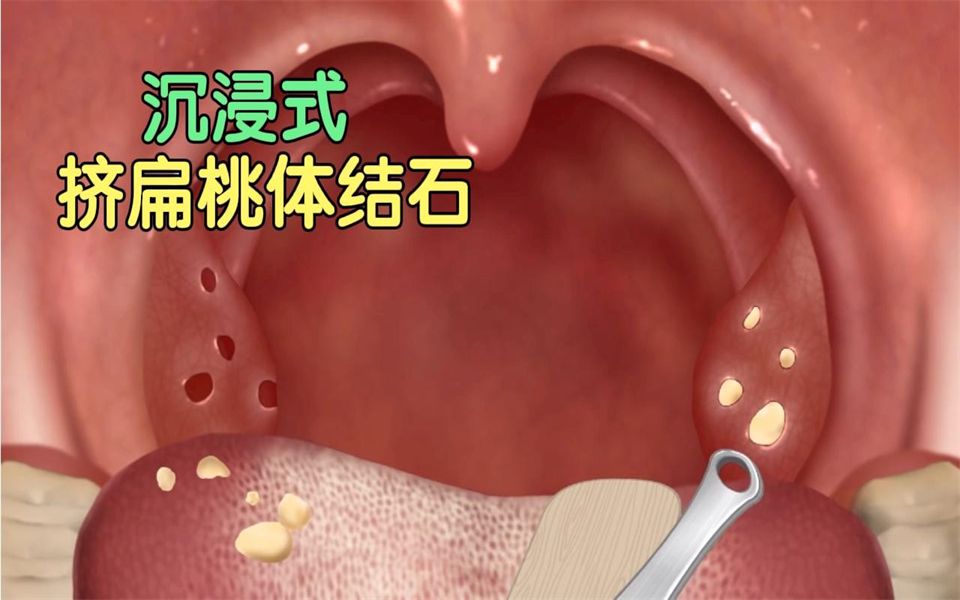美女嘴里经常冒出恶臭,原来是长了扁桃体结石,牙医挤出后不臭了