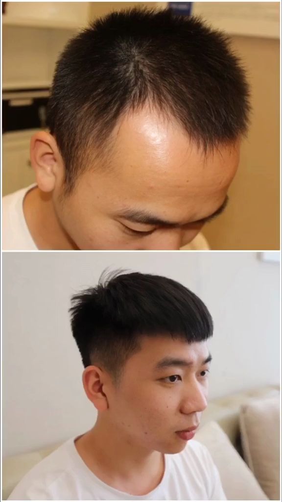 大麦微针植发效果,术后一年对比
