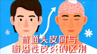 普通头皮屑与脂溢性皮炎的区别！