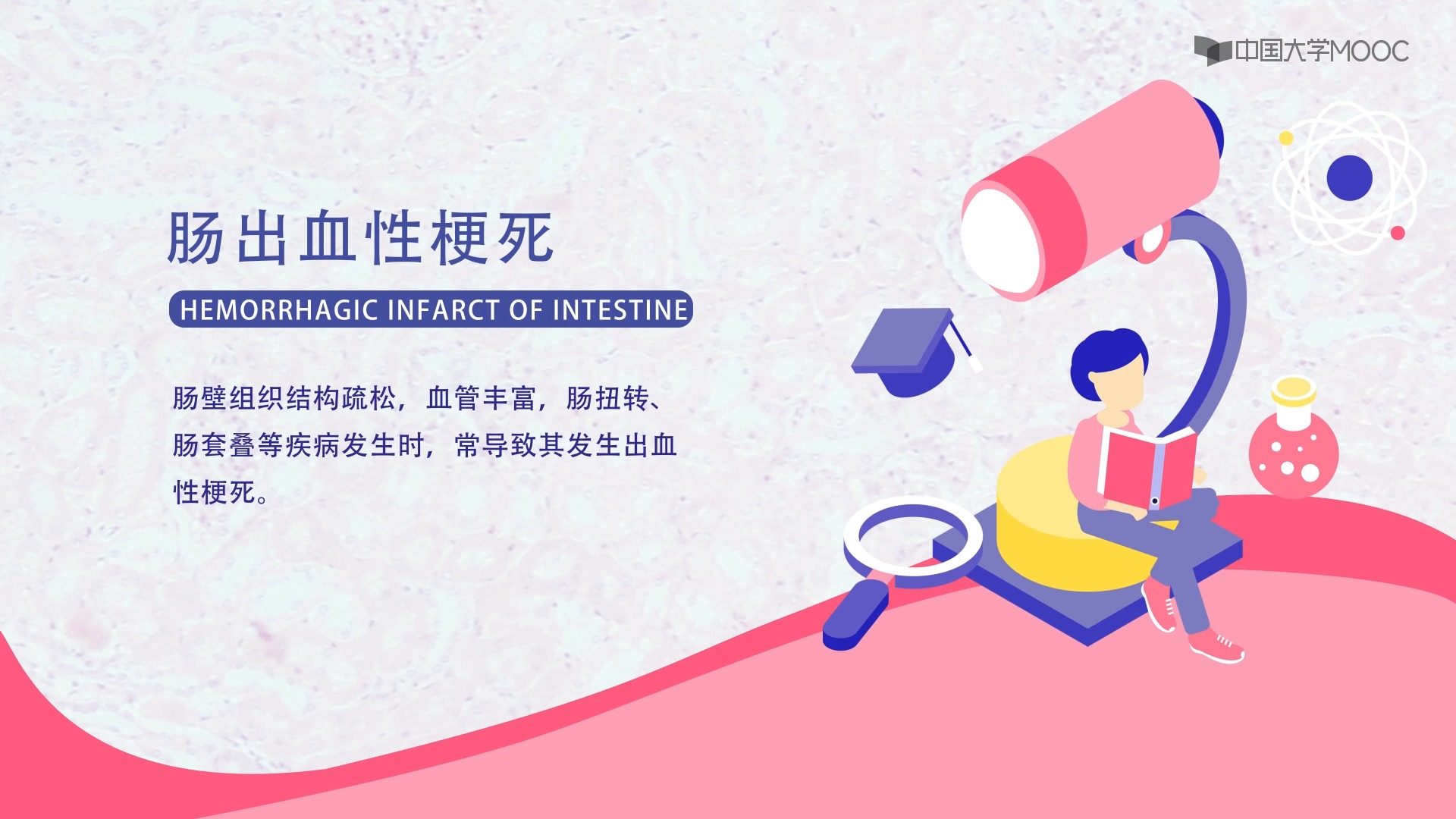 4.3]--微观探病--肠出血性梗死