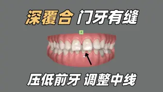 Télécharger la video: 矫正方案|深覆合，门牙有缝，中线不齐，不拔牙矫正，压低上下前牙，调整咬合关系！