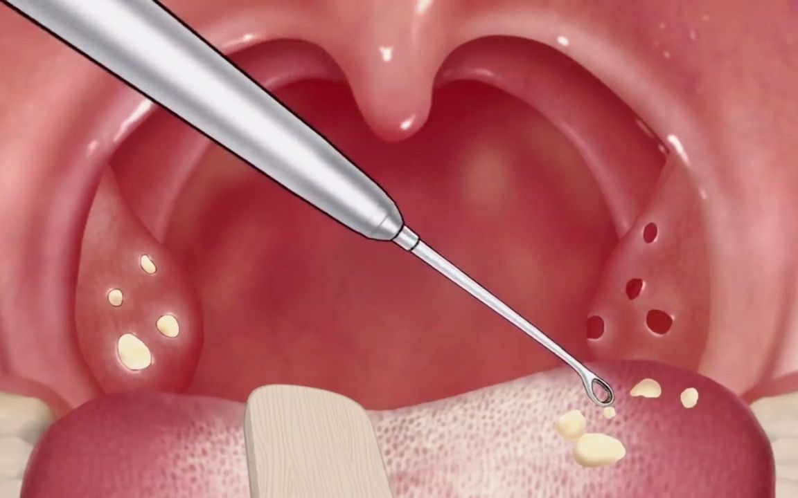 你聽說過扁桃體結石嗎?就是導致你口臭的原因
