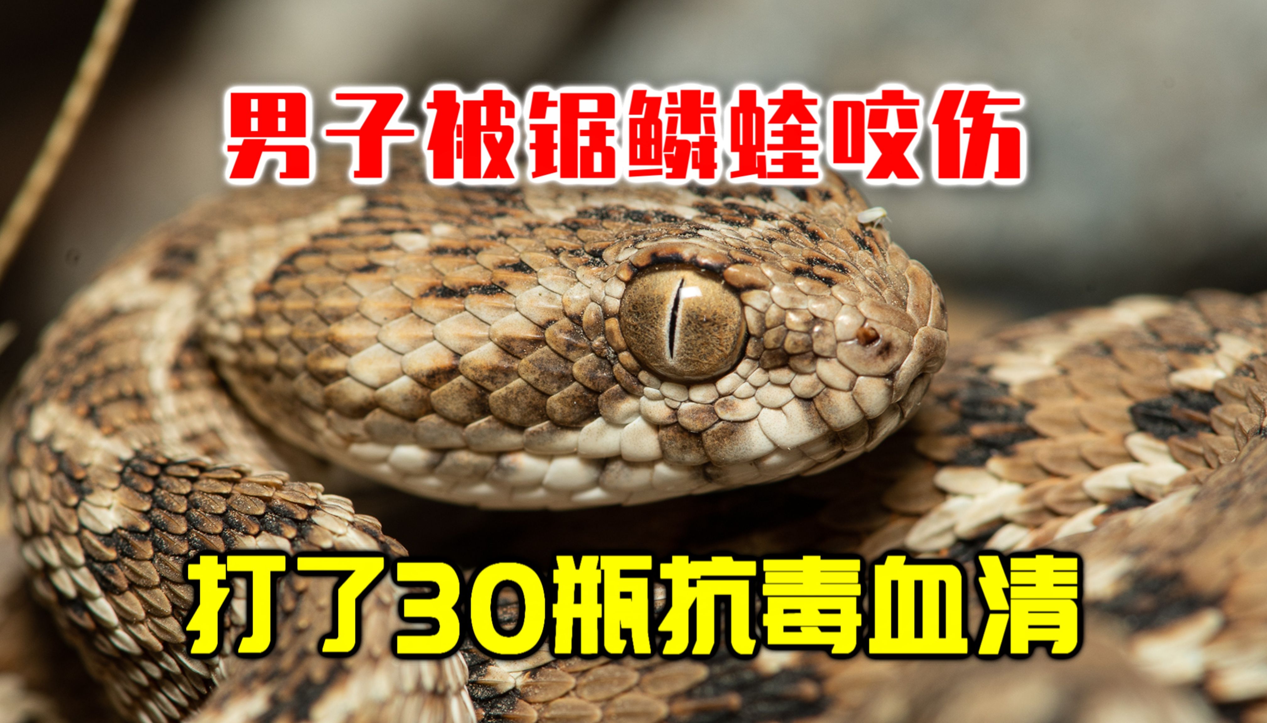 60岁男子被锯鳞蝰咬伤!凝血系统彻底崩溃!打了30瓶抗毒血清都无法逆转?-龙雅不爱吃-龙雅不爱吃-哔哩哔哩视频