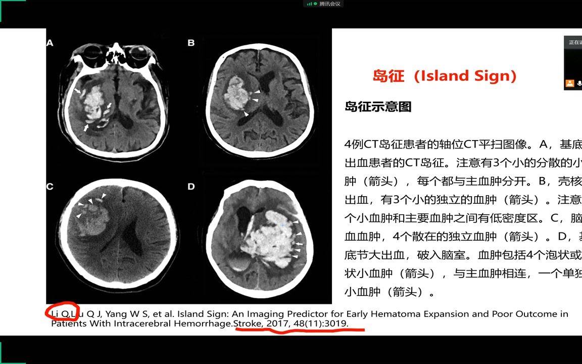 神经外科高血压脑出血的外科治疗①哔哩哔哩bilibili