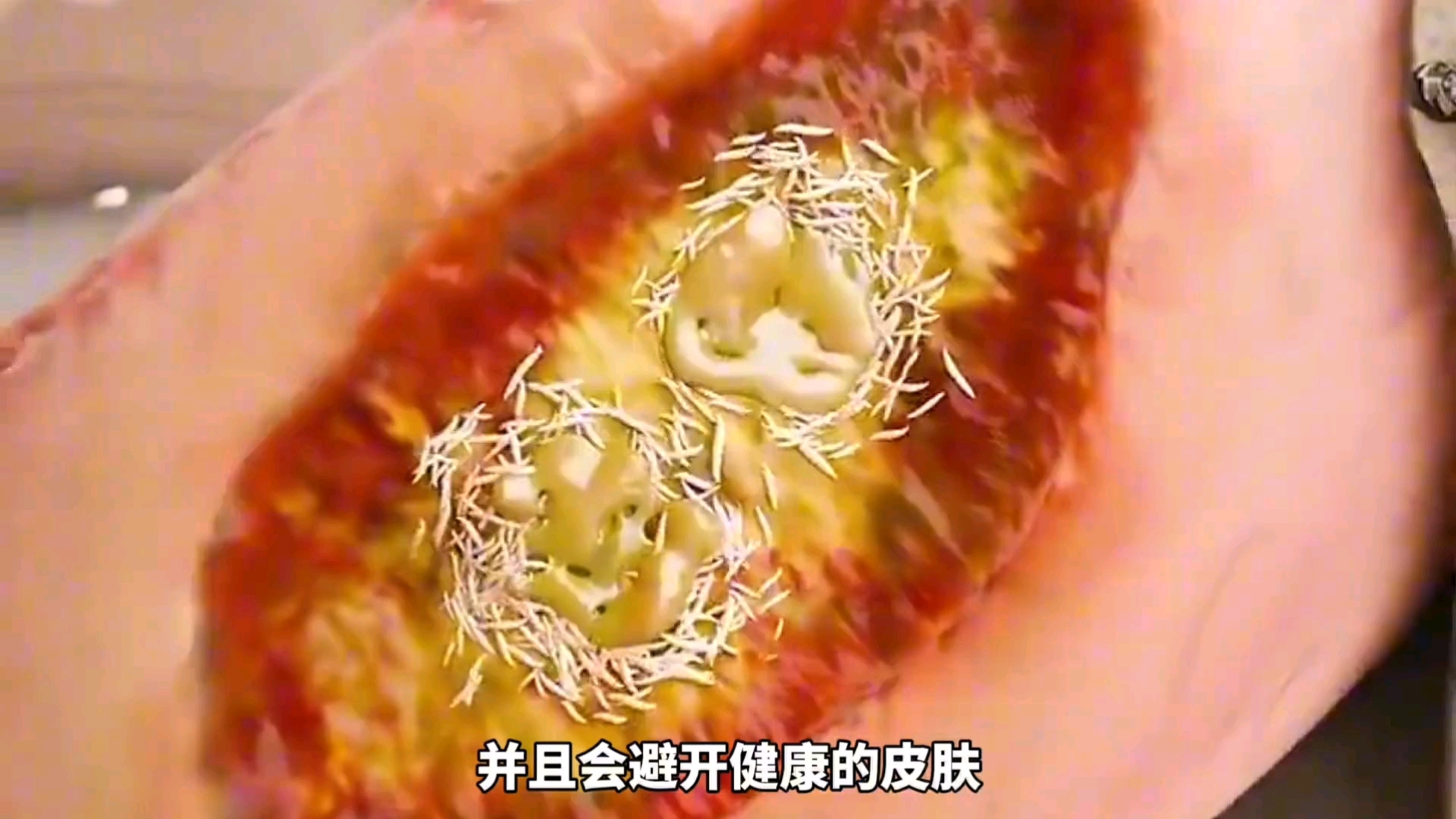 蛆虫也能用来治疗伤口