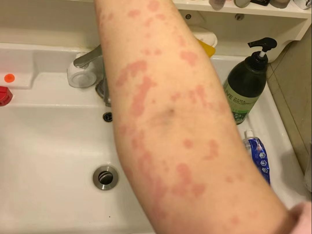 让我从浑身长红疹瘙痒到现在皮肤干净爽利,原来就是这三个简单好方法