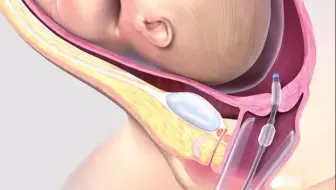 宫颈球囊扩张术【医学科普】