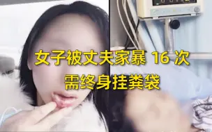 Descargar video: 女子被丈夫家暴16次，需终身挂粪袋