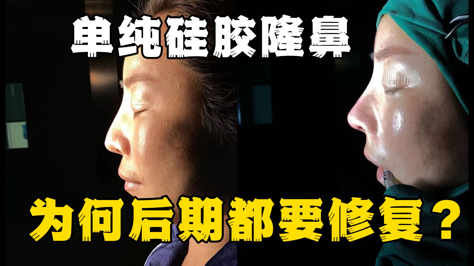 多年前的硅胶隆鼻,怎么修复?白志鹏鼻整形