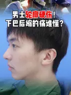 Tải video: 男士侧颜硬伤！下巴后缩的痛谁懂？