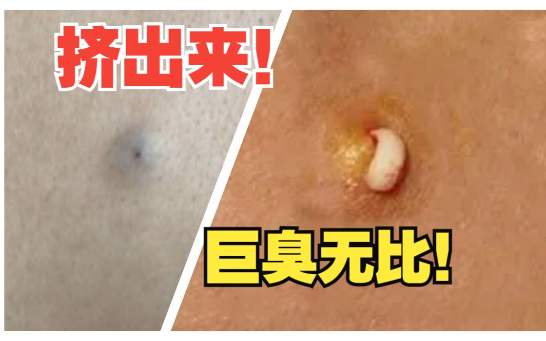 [图]#皮脂腺囊肿 挤出来超级臭！粉瘤应该怎么处理？#健康科普 #医学科普 #希望能帮到有需要的人