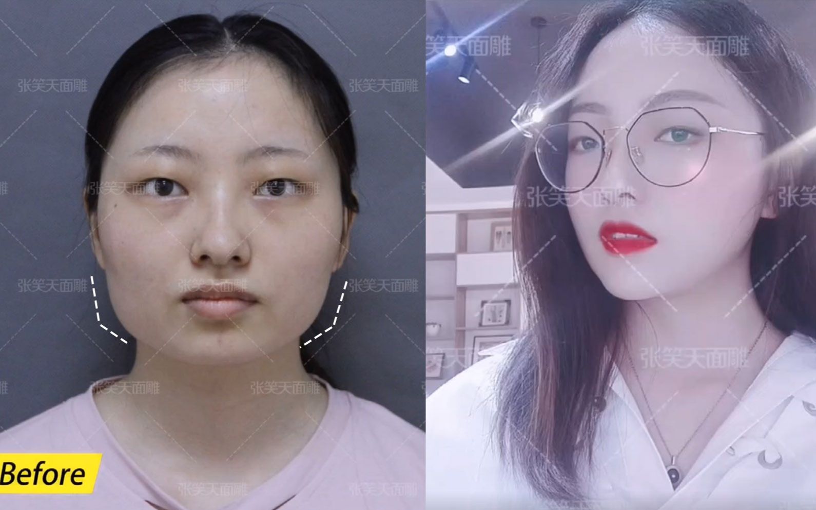 张笑天改脸型案例颧弓外扩下颌角宽大一次手术全解决