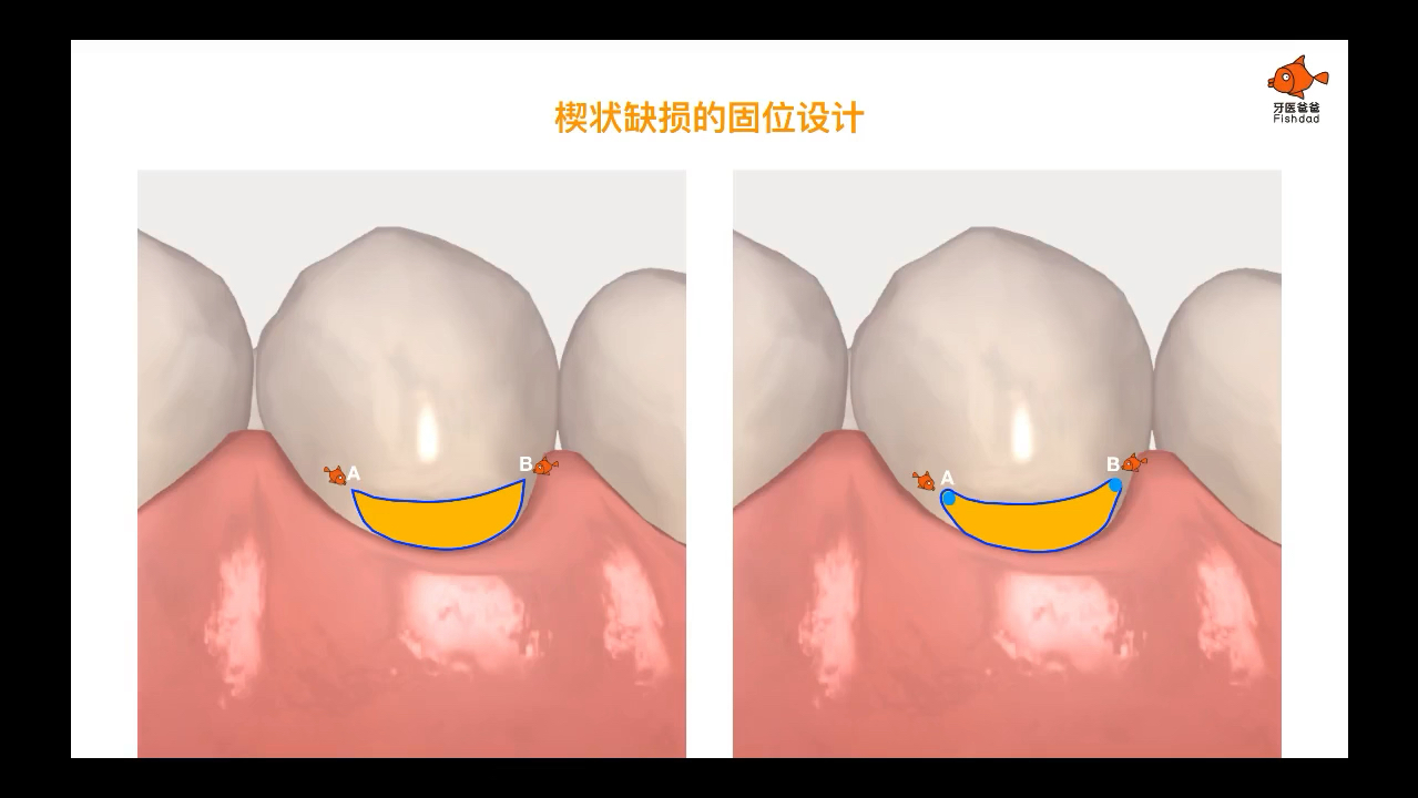 第4讲-后牙及楔状缺损的充填技巧——〔 王磊-带你玩转树脂美学系列课