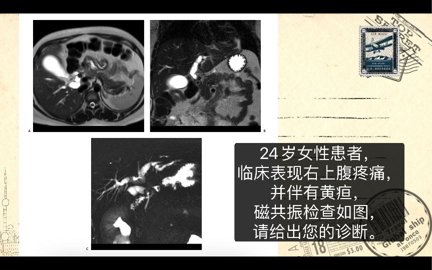 mirizzi综合征:让你痛不欲生的疾病