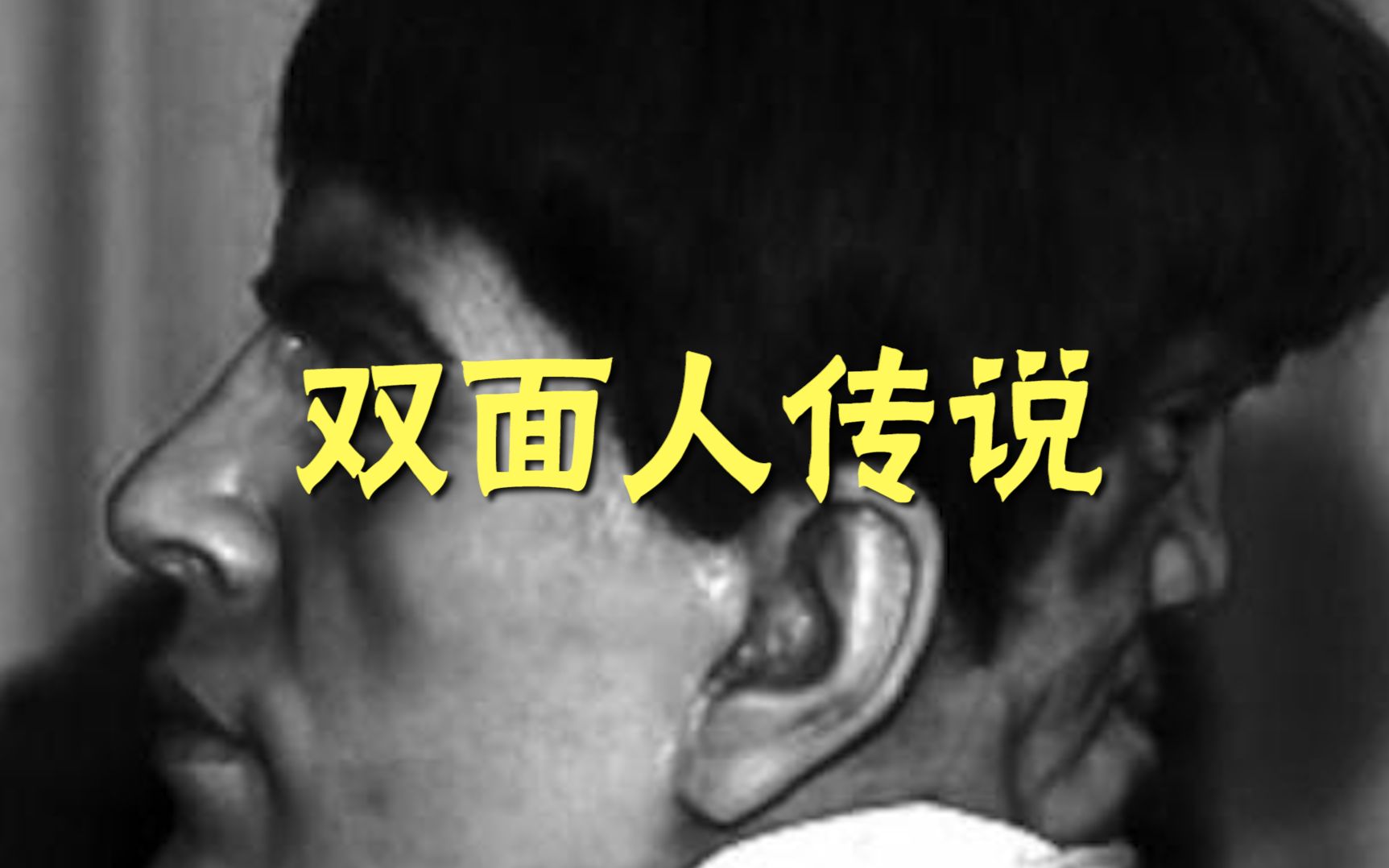 传说中长着两张脸的"双面人"爱德华·莫达克,可能患有一种先天疾病