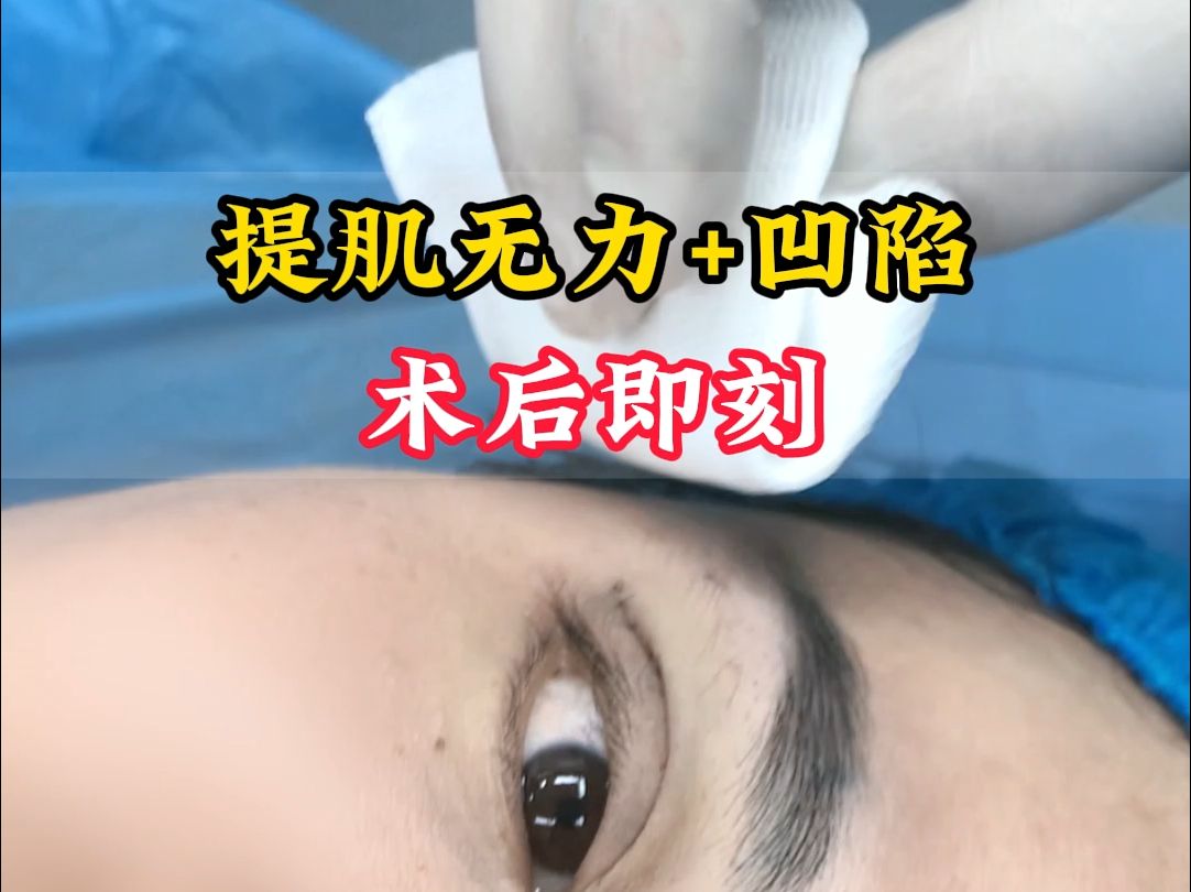 7.0mm开扇双眼皮,术后即刻记录哔哩哔哩bilibili