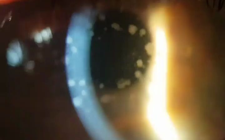 斑点状角膜营养不良(macular corneal dystrophy)哔哩哔哩bilibili