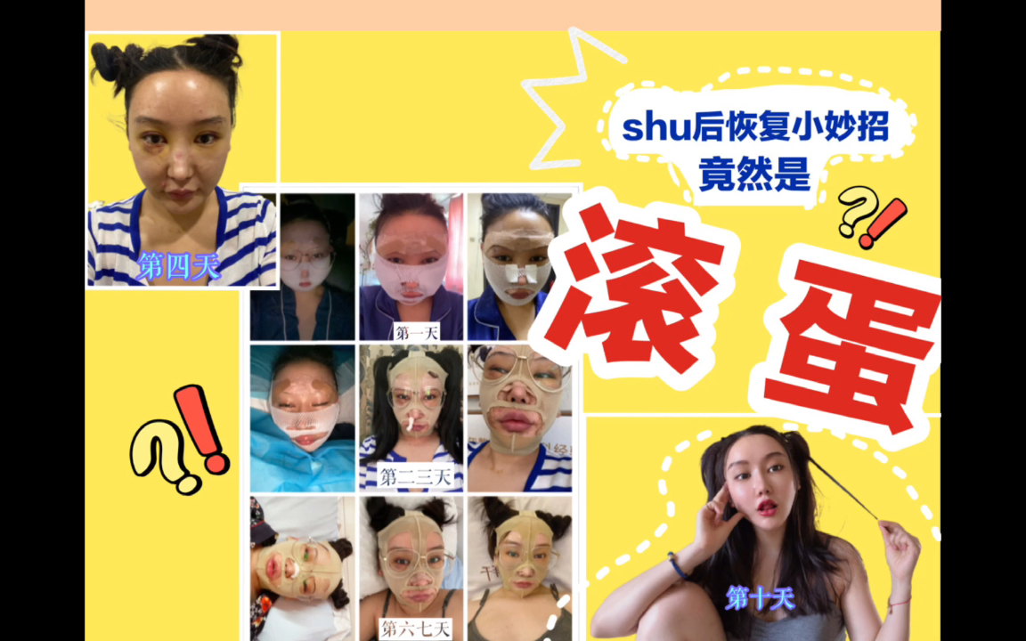 怎样快速消肿消淤青?医美shu后恢复干货分享哔哩哔哩bilibili