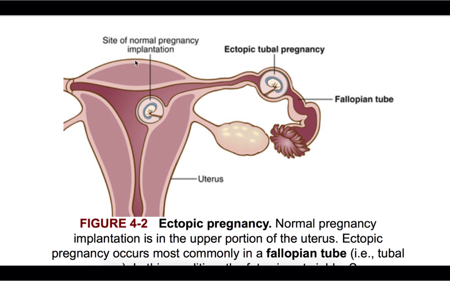 ectopicpregnancy异位妊娠医学英语每日学day34