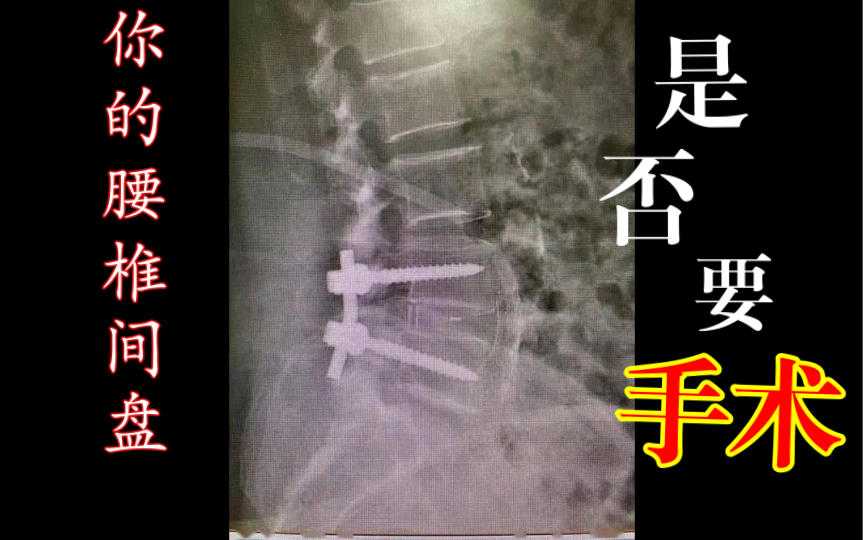 [图]【腰背维修师】腰突手术前建议看看｜你可以试试虚拟手术