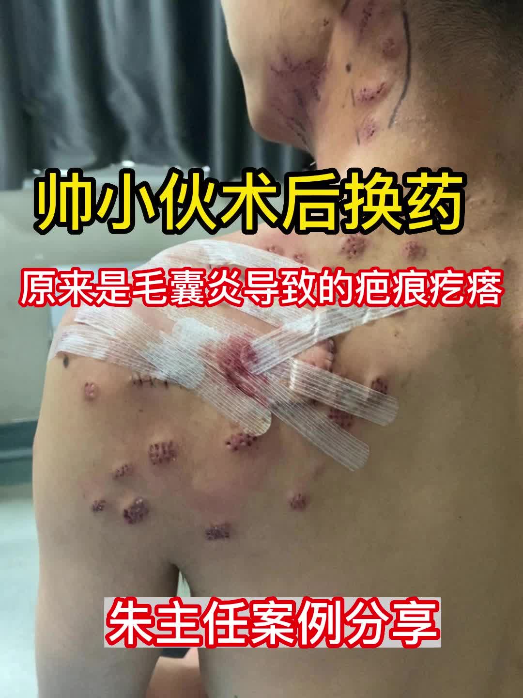 帥小夥術後換藥,1顆毛囊炎變成一身疤痕疙瘩