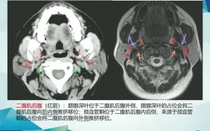 下载视频: 10.腮腺良性肿瘤-头颈影像诊断系列1