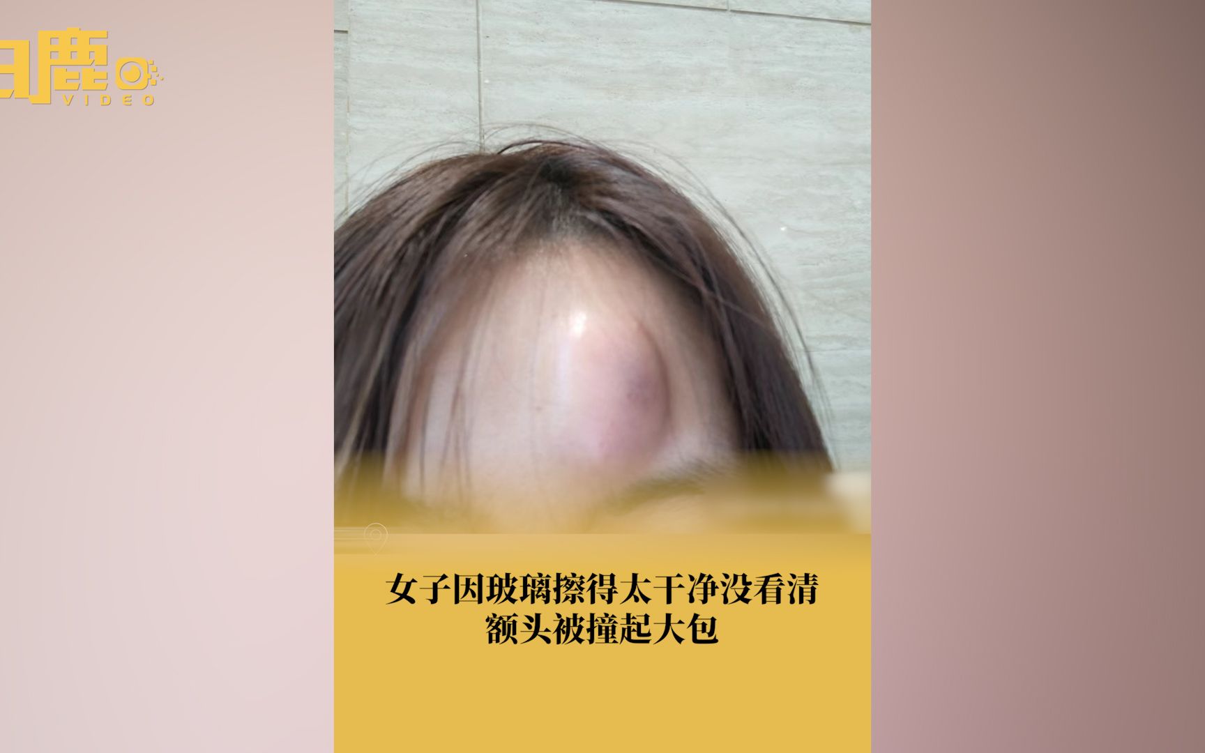 女生小跑撞上玻璃额头肿拳头大包