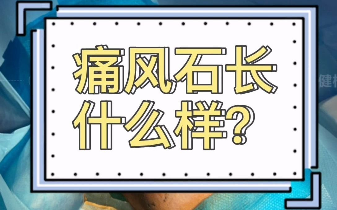 上海健桥医院:痛风石长什么样哔哩哔哩bilibili