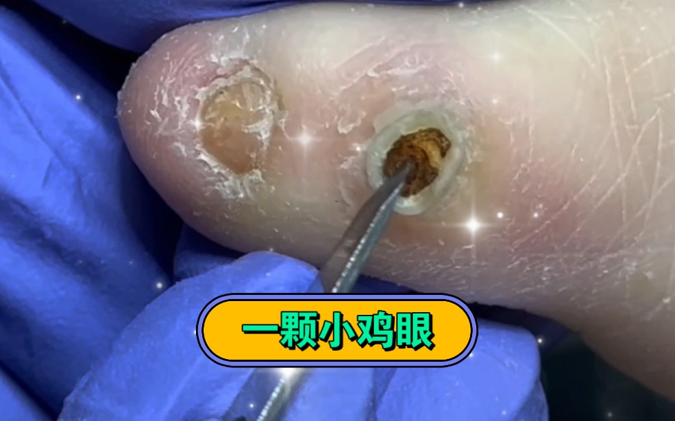 为什么脚上会长鸡眼,怎么治疗为什么在线 为什么脚上会长鸡眼,怎么治疗为什么在线