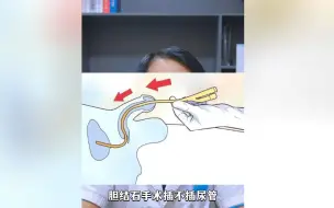 下载视频: 胆结石手术是否要插尿管