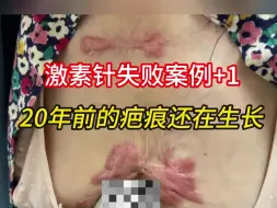 Download Video: 迟到了20年的确诊，阿姨切了耳垂、前胸腹部爬满疤痕增生后泪目