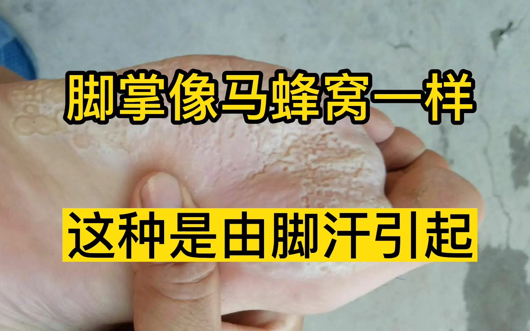 脚臭脚汗多脚掌像马蜂窝一样-手把手教你解决