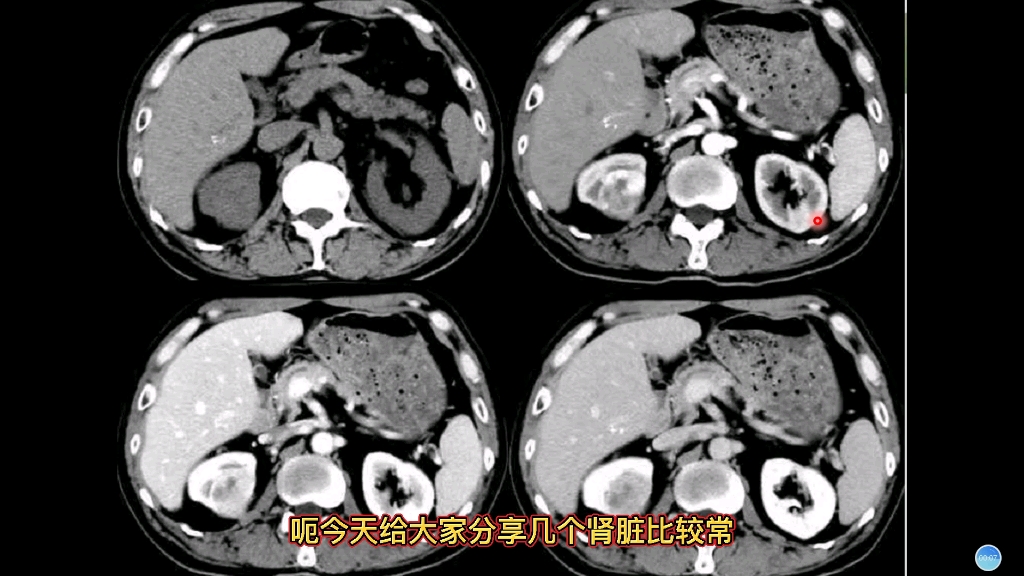 肾脏三种不同类型肾癌在CT上都是什么表现?放射科医生讲解哔哩哔哩bilibili