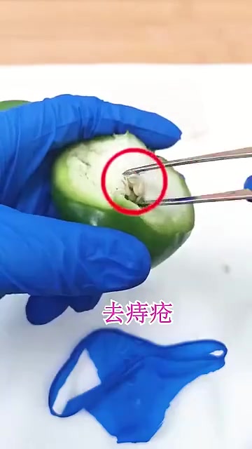 近距离观察痔疮手术98【轻松一刻】