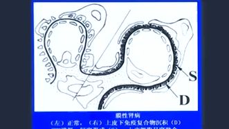 05.肾病综合征(概述、病理生理、病因、病理类型及临床特征)哔哩哔哩bilibili